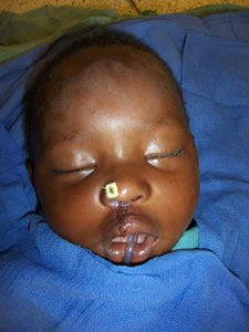 Post operative cleft surgery on baby