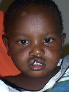 Pre-operative cleft surgery on baby