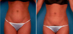 abdominoplasty