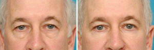 Actual Patient Before and After Lower Blepharoplasty with suspension to remove eyelid puffiness and circles (lid cheek junction deformity).