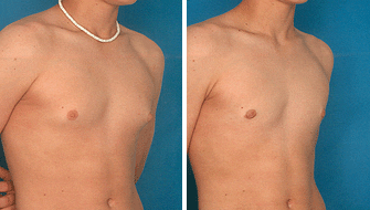 Male Breast Reduction for Gynecomastia in Orlando, FL - DrGeorge Pope