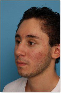 Craniofacial After Fat