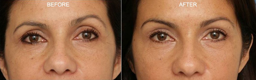 Orbital Fat Injections from Patrick K. Sullivan, MD, FACS - Upper Eyelid / Brow Junction Treatment