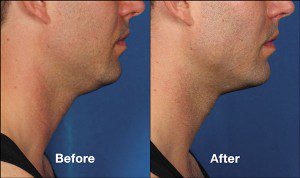 KybellaPatientPRI2BeforeAfter(SideView)