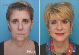 dr sullivan facelift patient