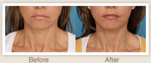 facial-rejuvenation-case