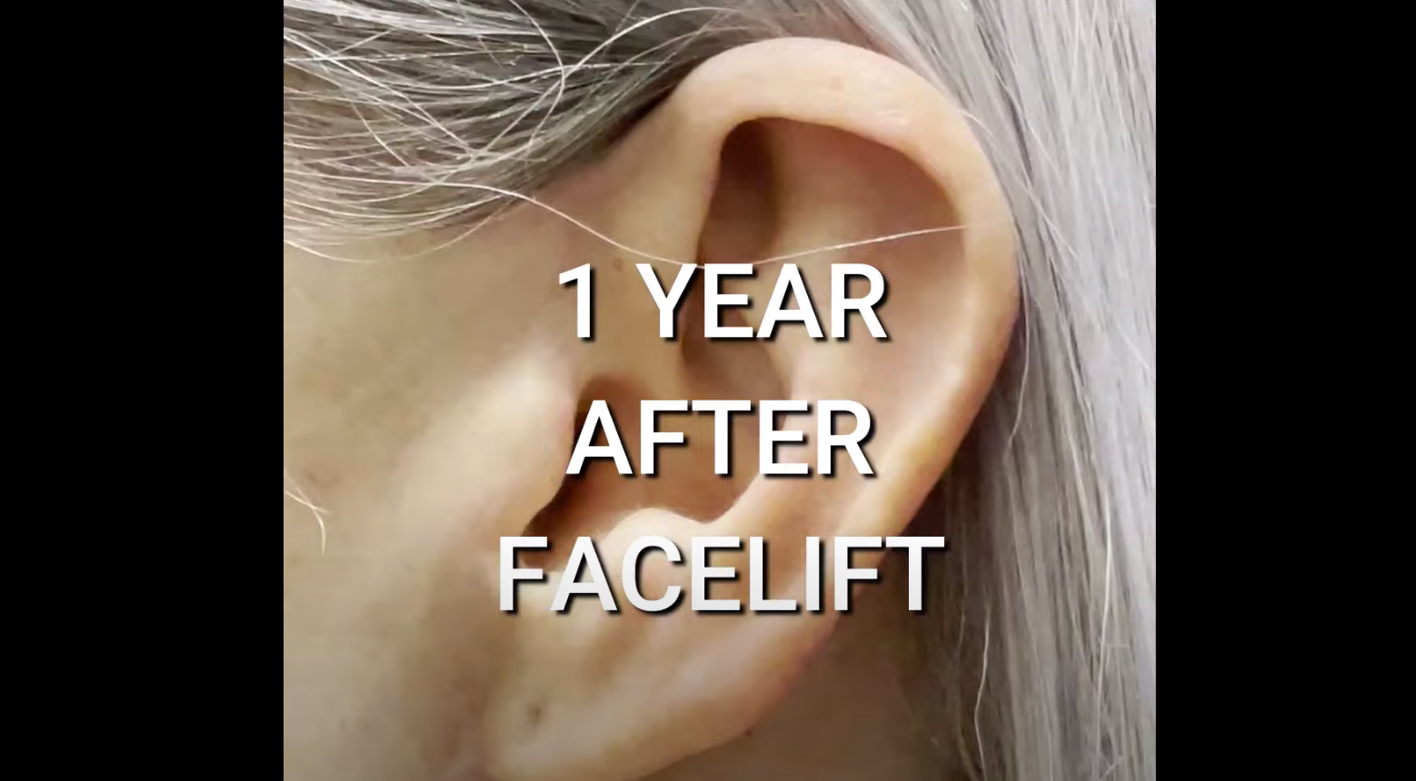 Facelift - NO SCARS! | Patient Perspective