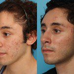 Rhode Island plastic surgeon, Patrick K. Sullivan MD, fat injections