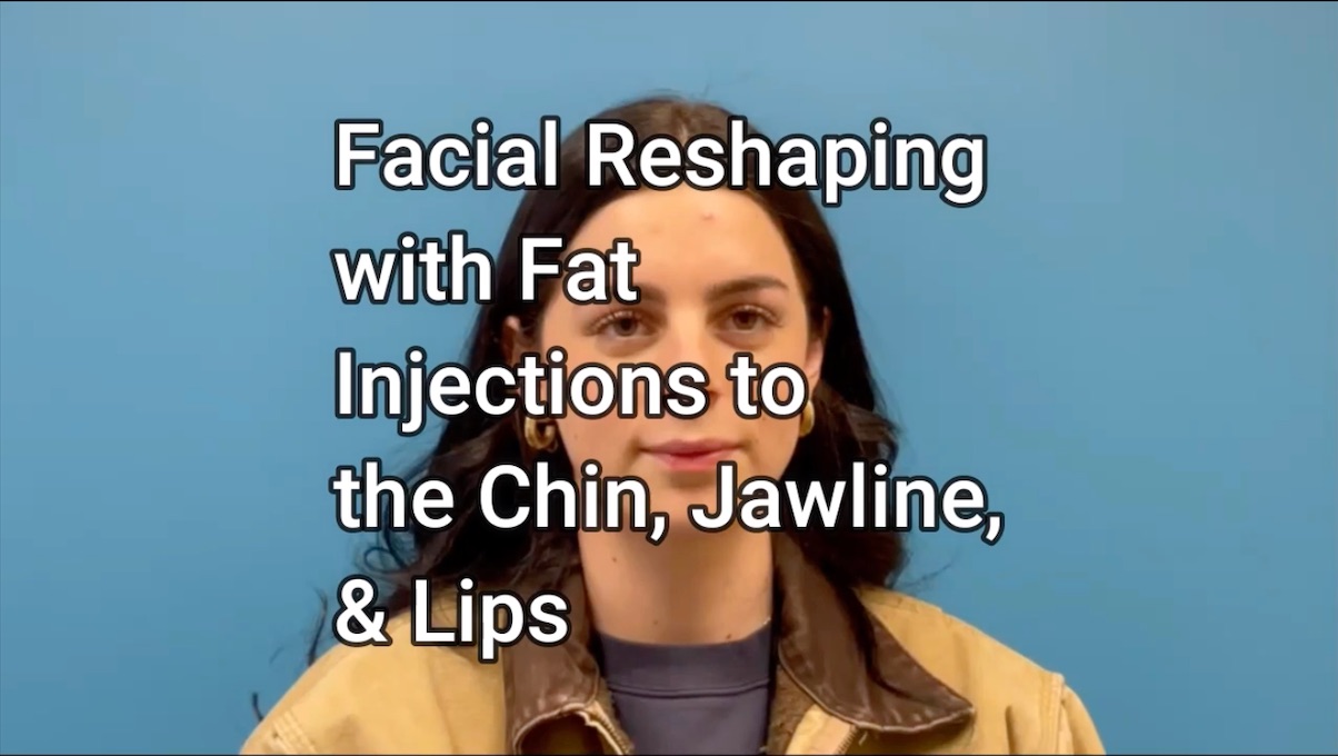 Facial Contouring Part 2 | Patient Perspective